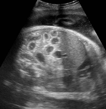 Ileal atresia | Image | Radiopaedia.org