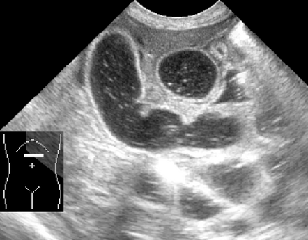 Ileal atresia | Image | Radiopaedia.org