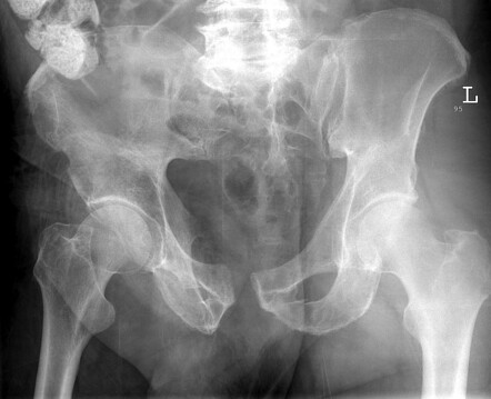 Young and Burgess classification of pelvic ring fractures | Radiology ...