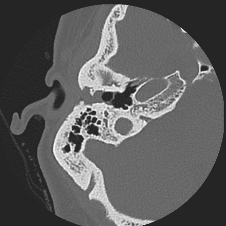 External auditory canal cholesteatoma | Radiology Case | Radiopaedia.org