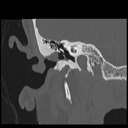 External auditory canal cholesteatoma | Image | Radiopaedia.org