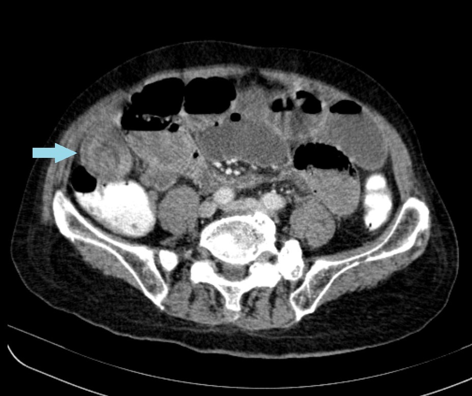 File:Small bowel volvulus causing small bowel obstruction, mimicking ...