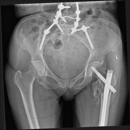 Comminuted intertrochanteric neck of femur fracture (X-Ray and CT ...