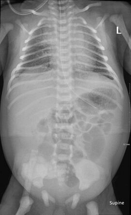 Ileal atresia | Radiology Case | Radiopaedia.org