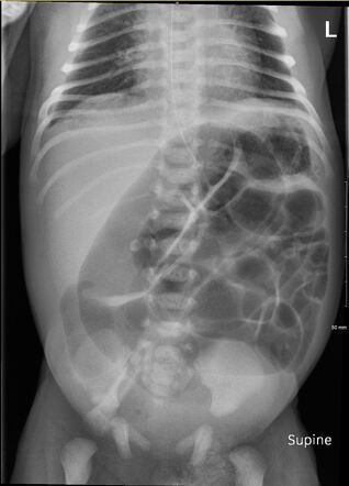 Ileal atresia | Radiology Reference Article | Radiopaedia.org