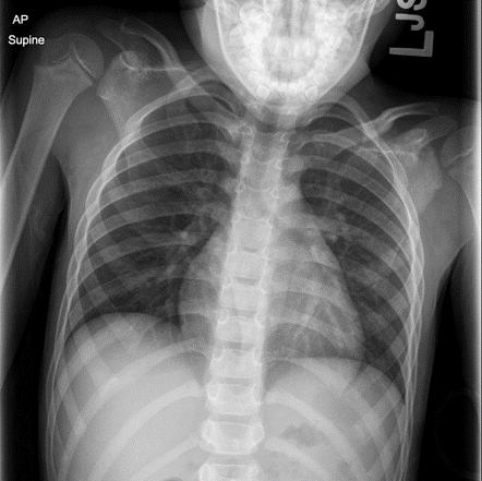 Normal chest radiograph - paediatric | Radiology Case | Radiopaedia.org