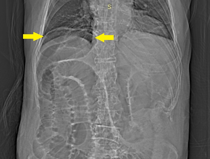 File:Small bowel volvulus causing small bowel obstruction, mimicking ...