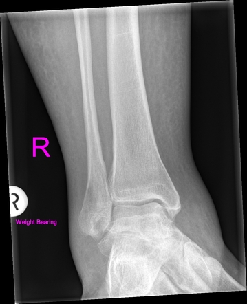 Subtalar osteoarthritis | Image | Radiopaedia.org