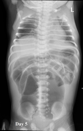 Ileal atresia | Image | Radiopaedia.org