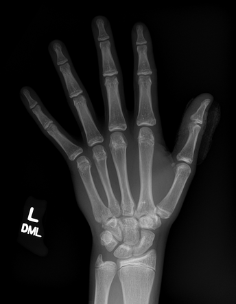 Normal hand series - pediatric | Radiology Case | Radiopaedia.org