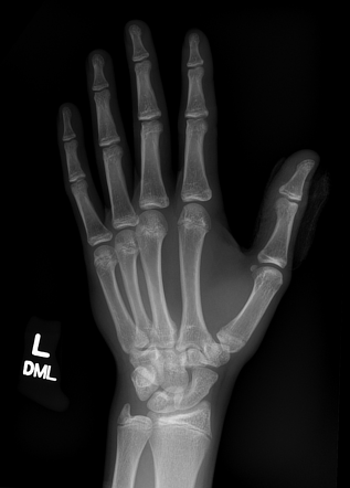 Normal hand series - pediatric | Image | Radiopaedia.org