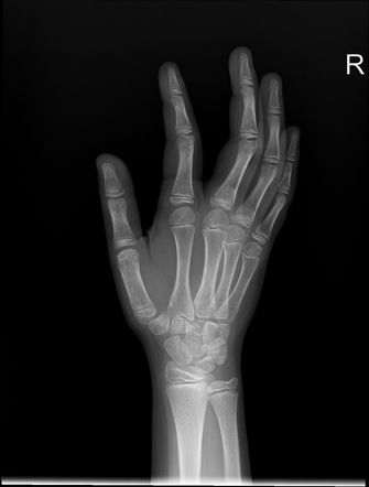 Normal hand series - pediatric | Image | Radiopaedia.org