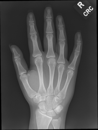 Normal hand series - paediatric | Radiology Case | Radiopaedia.org