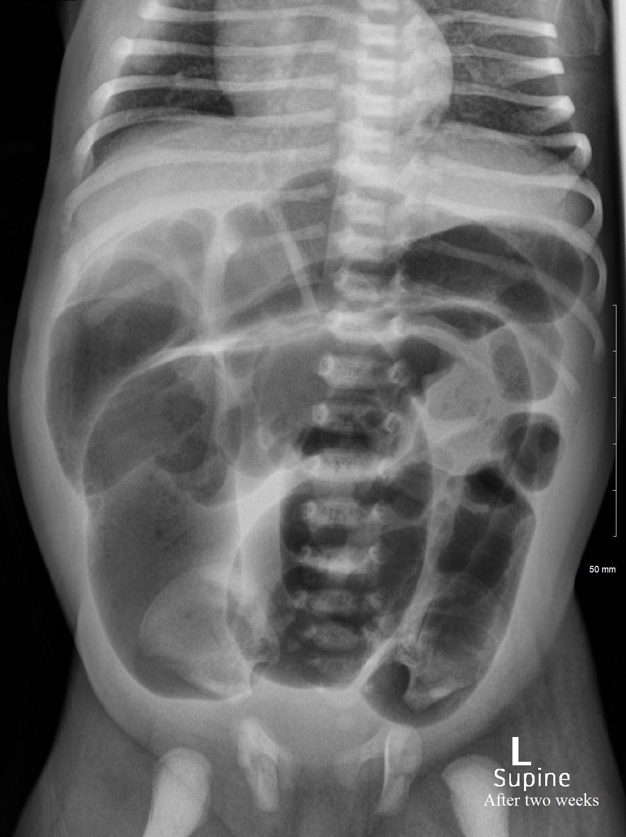 Neonatal bowel obstruction - post-surgical stenosis | Image ...