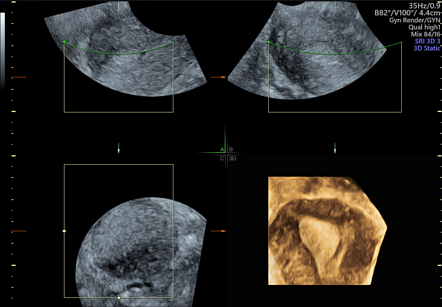 Endometrial polyp | Radiology Reference Article | Radiopaedia.org