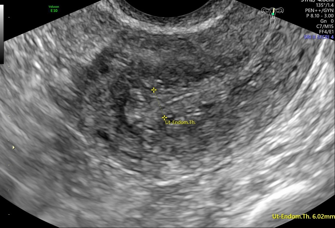 Leiomyolipoma | Image | Radiopaedia.org