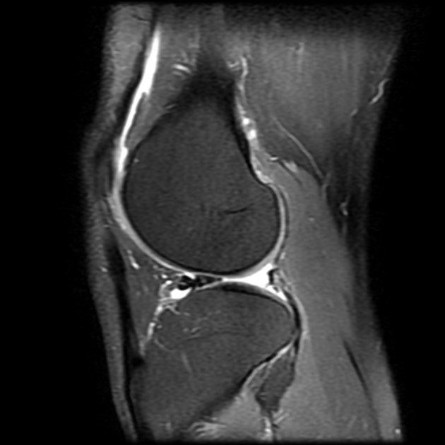 Flipped lateral meniscus | Image | Radiopaedia.org