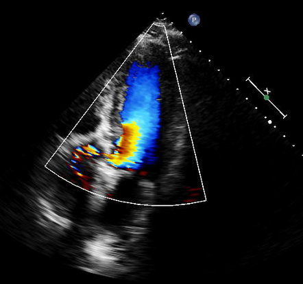 Holodiastolic flow reversal (echocardiography) | Radiology Case ...