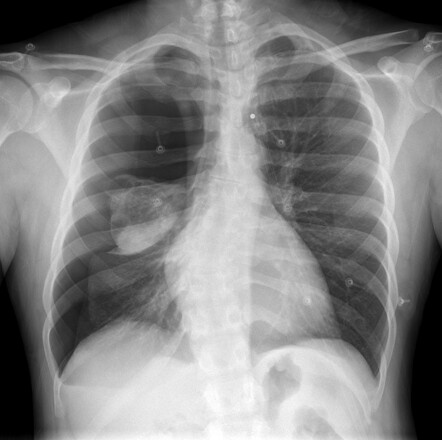 Pneumothorax due to rupture of a bulla | Image | Radiopaedia.org