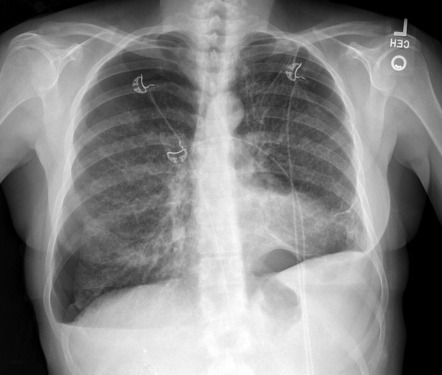 Pneumothoraces due to tuberous sclerosis | Radiology Case | Radiopaedia.org