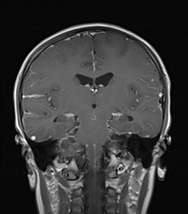 Tuberculous Meningitis | Image | Radiopaedia.org