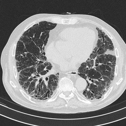 Usual interstitial pneumonia | Radiology Reference Article ...