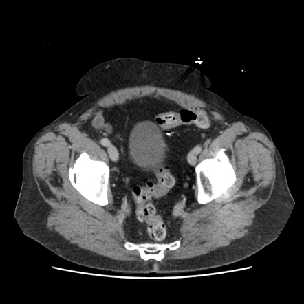 Cystic duct dilation from obstructed CBD stent | Radiology Case ...