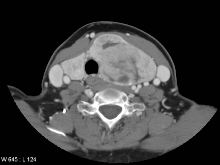 Goiter - intrathoracic | Image | Radiopaedia.org