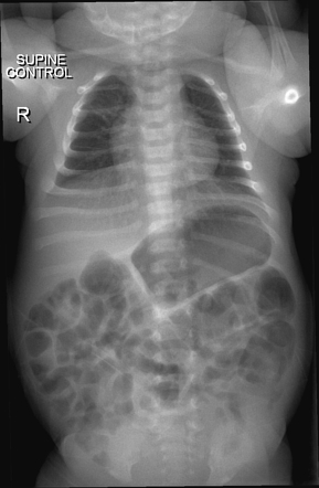 Aberrant right subclavian artery | Radiology Case | Radiopaedia.org