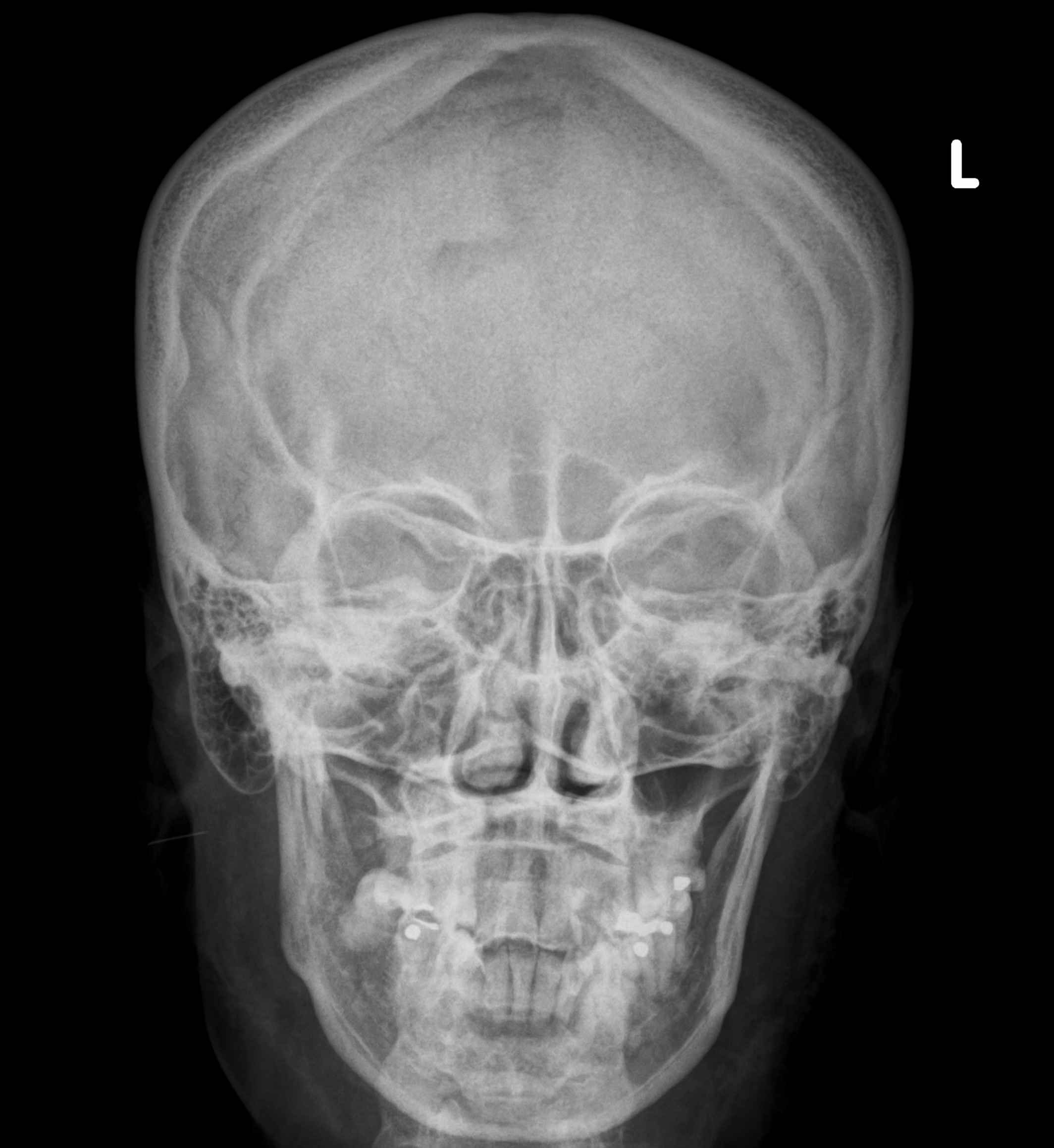 Retained Needle Fragment Within Subcutaneous Facial Dermal Filler 