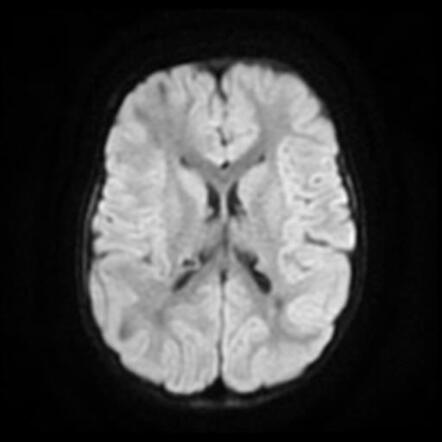 Tuberous sclerosis | Image | Radiopaedia.org