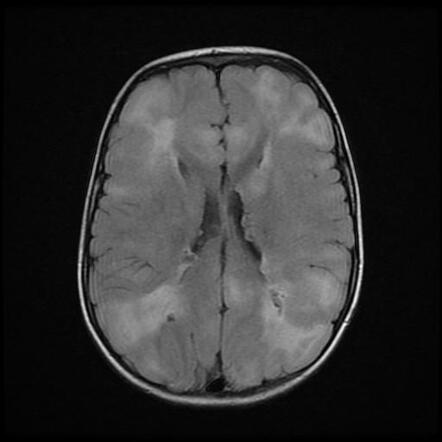 Tuberous sclerosis | Radiology Case | Radiopaedia.org