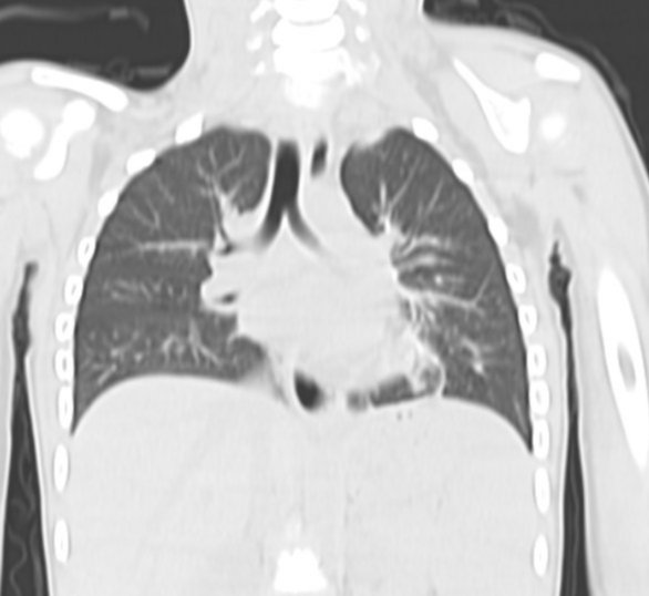 Sprengel Deformity In Klippel Feil Syndrome Image