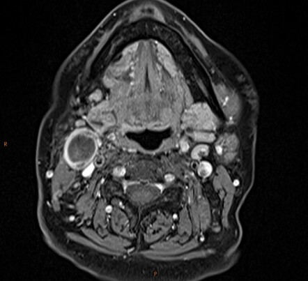 Playlist 'Radiopaedia 2023: Cervical lymph node assessment' by Dr Derek ...