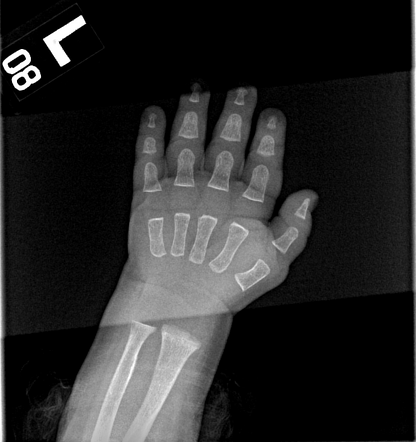 Normal hand radiograph - infant | Radiology Case | Radiopaedia.org