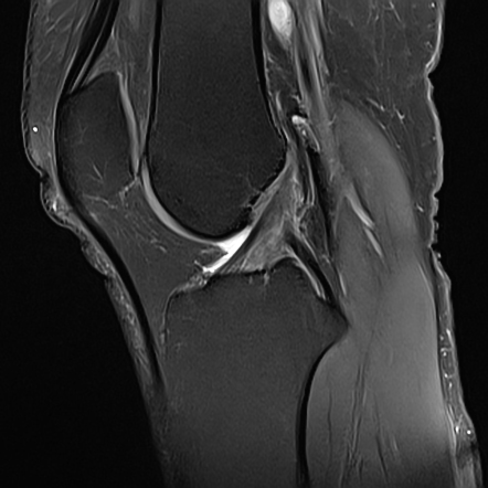 Prefemoral fat pad impingement syndrome | Radiology Case | Radiopaedia.org