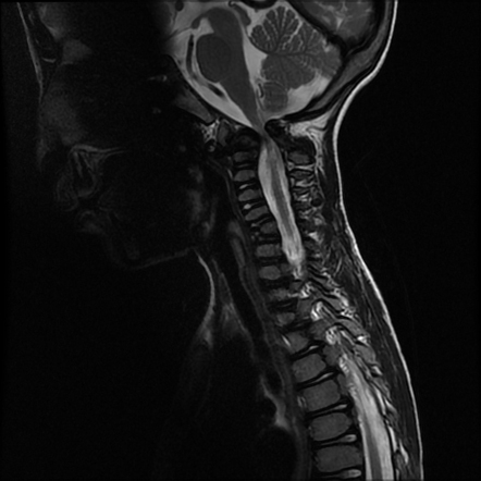 Dystopic os odontoideum with compressive myelopathy | Radiology Case ...