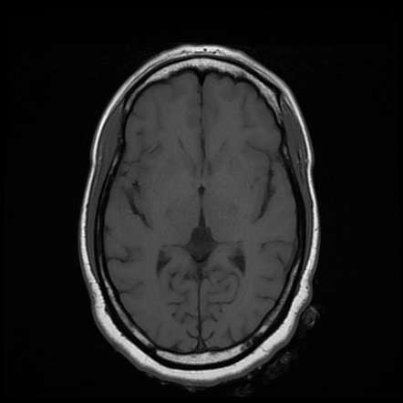 Progressive Multifocal Leukoencephalopathy (PML) | Image | Radiopaedia.org