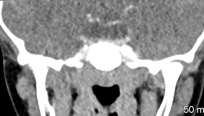 Internal Angular Orbital Dermoid Cyst Fluid Density Image