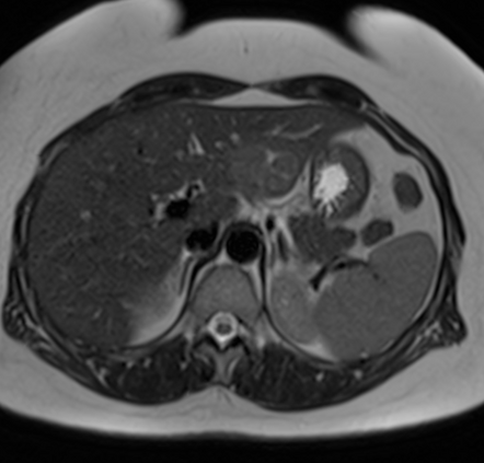 Focal nodular hyperplasia | Radiology Case | Radiopaedia.org