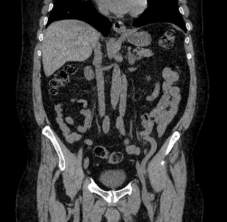 Cystitis cystica | Radiology Reference Article | Radiopaedia.org