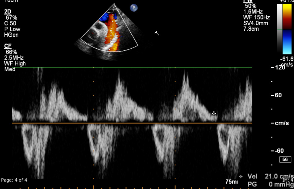 Holodiastolic flow reversal (echocardiography) | Image | Radiopaedia.org