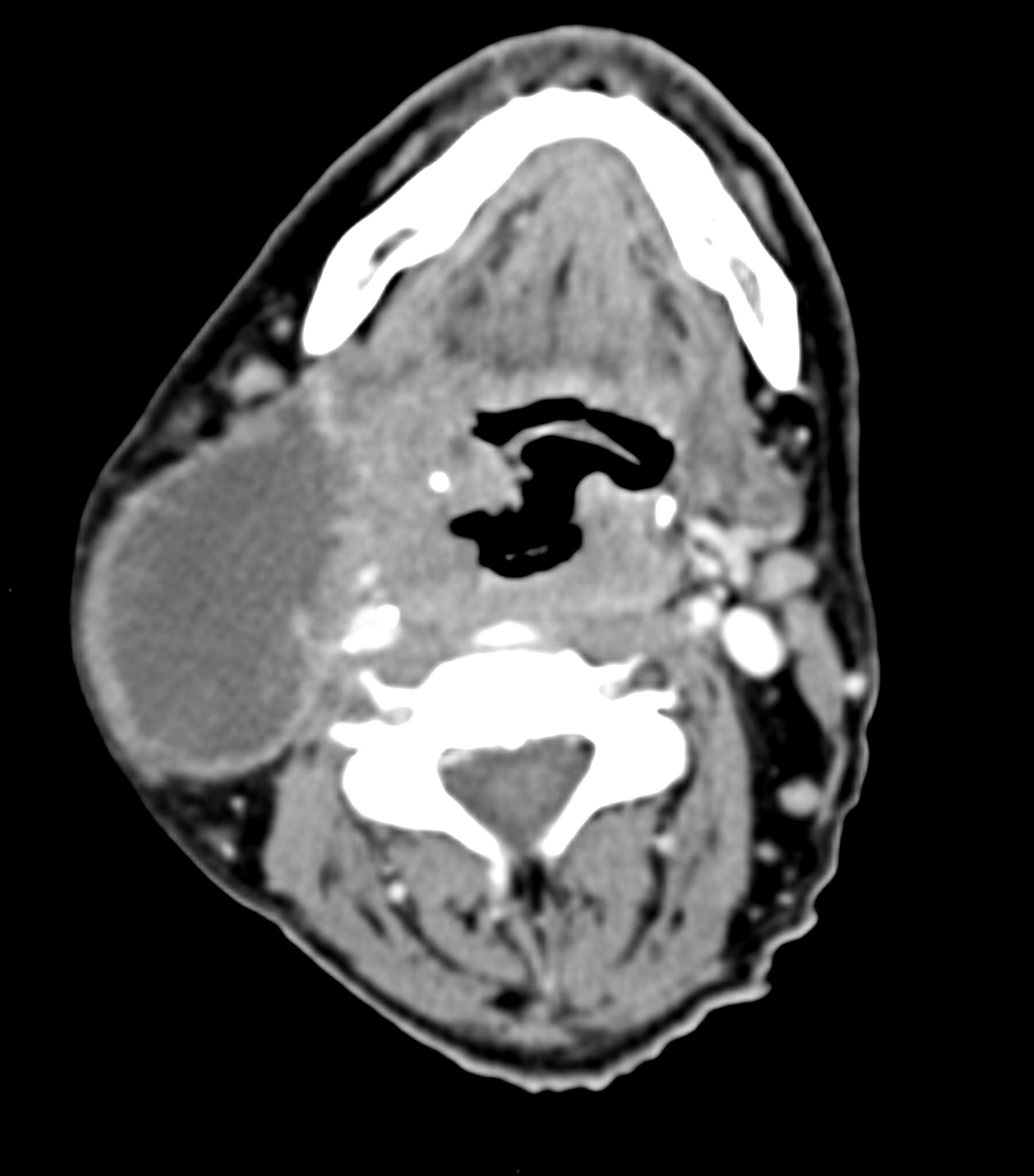 Oropharyngeal squamous cell carcinoma (p16 positive; T4 cN3 M1) | Image ...