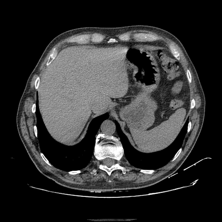 Giant urinary bladder diverticulum | Radiology Case | Radiopaedia.org