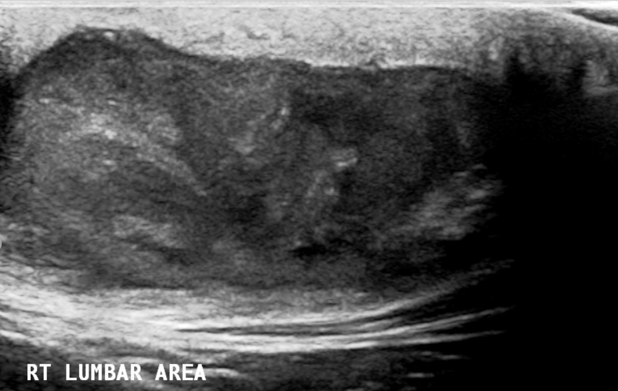 Epidermoid Cyst Image 