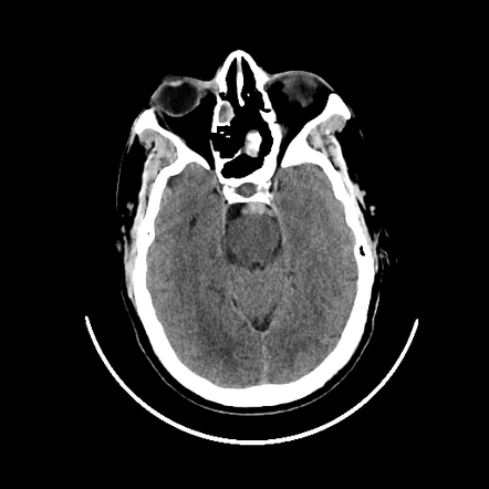 Non-aneurysmal perimesencephalic subarachnoid hemorrhage | Radiology ...