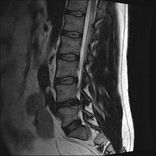 LUMBAR SPINE  Musculoskeletal Key