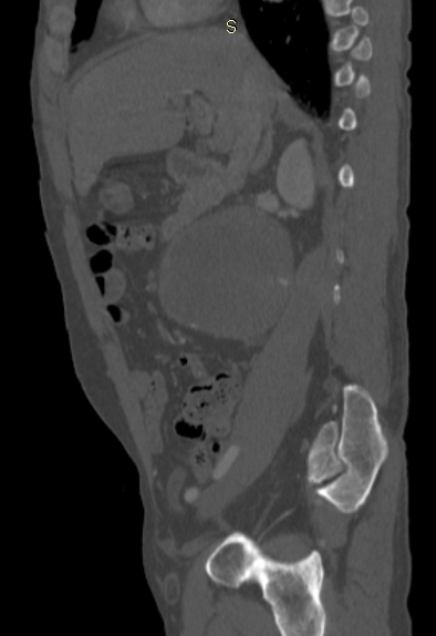 Retroperitoneal Hydatid Cyst Image