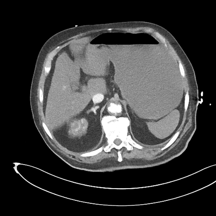 Bilateral adrenal gland hyperenhancement | Radiology Reference Article ...