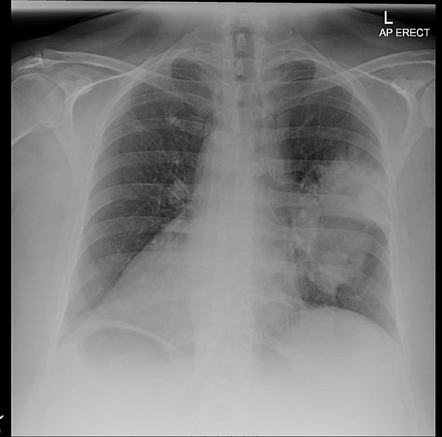 Pneumonia | Radiology Case | Radiopaedia.org